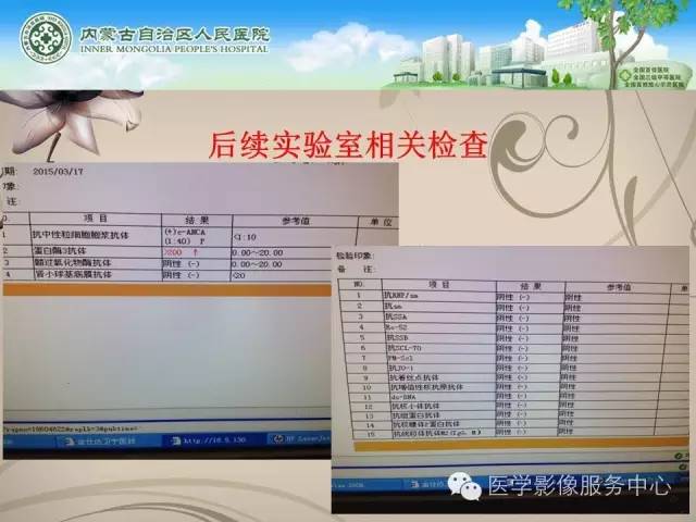 【病例】肺韦格氏肉芽肿1例CT影像表现