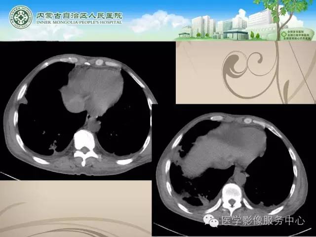 【病例】肺韦格氏肉芽肿1例CT影像表现