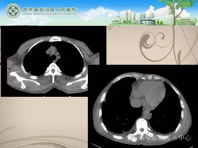【病例】肺韦格氏肉芽肿1例CT影像表现