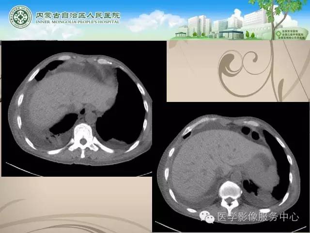 【病例】肺韦格氏肉芽肿1例CT影像表现