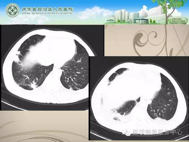 【病例】肺韦格氏肉芽肿1例CT影像表现