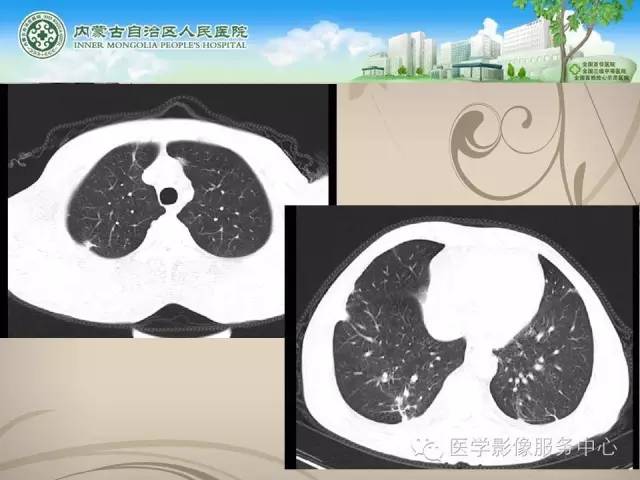 【病例】肺韦格氏肉芽肿1例CT影像表现
