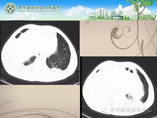 【病例】肺韦格氏肉芽肿1例CT影像表现