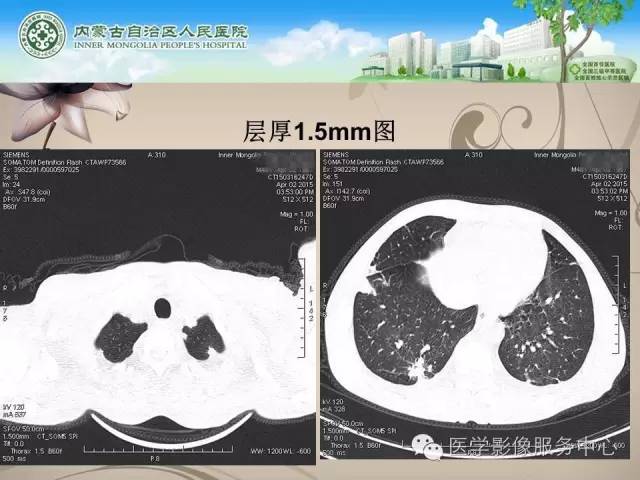 【病例】肺韦格氏肉芽肿1例CT影像表现