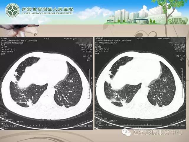 【病例】肺韦格氏肉芽肿1例CT影像表现