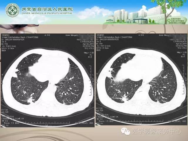 【病例】肺韦格氏肉芽肿1例CT影像表现