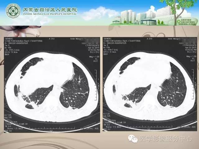 【病例】肺韦格氏肉芽肿1例CT影像表现