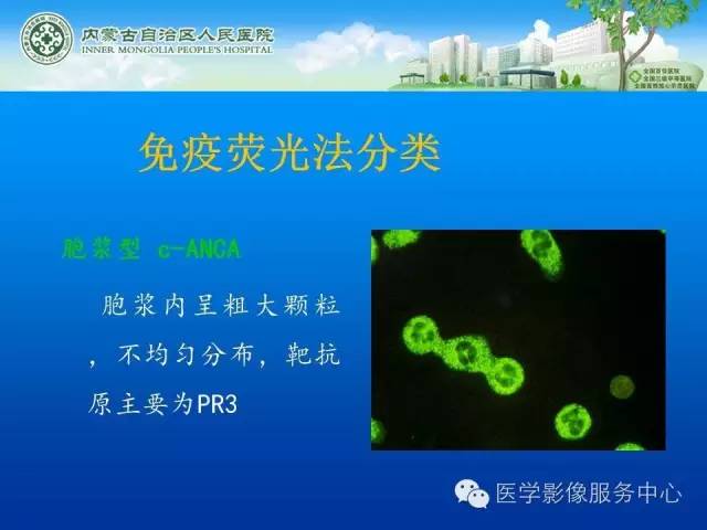 【病例】肺韦格氏肉芽肿1例CT影像表现