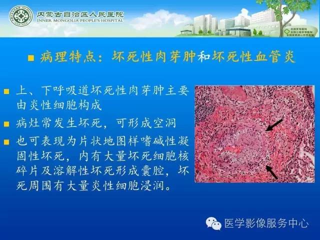 【病例】肺韦格氏肉芽肿1例CT影像表现