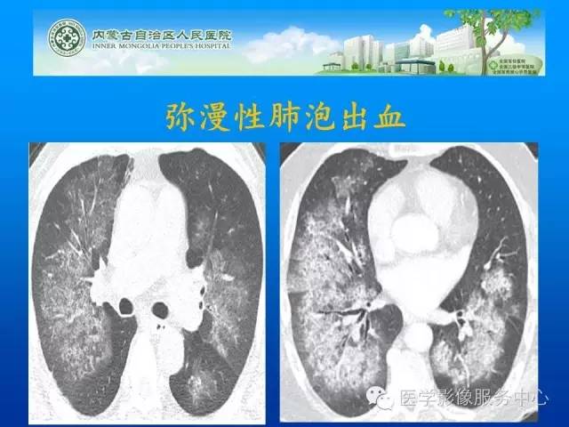 【病例】肺韦格氏肉芽肿1例CT影像表现