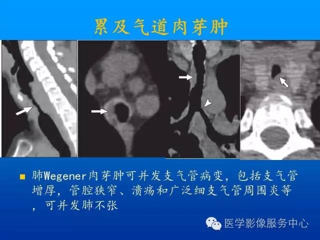 【病例】肺韦格氏肉芽肿1例CT影像表现