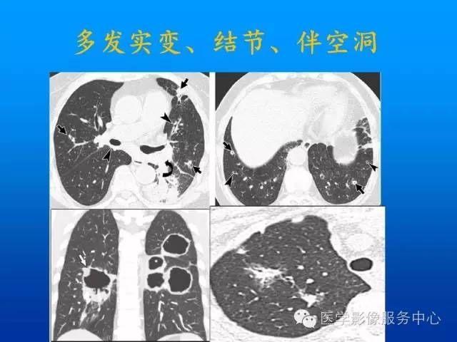 【病例】肺韦格氏肉芽肿1例CT影像表现