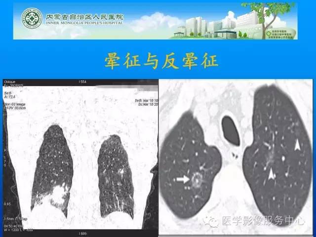 【病例】肺韦格氏肉芽肿1例CT影像表现