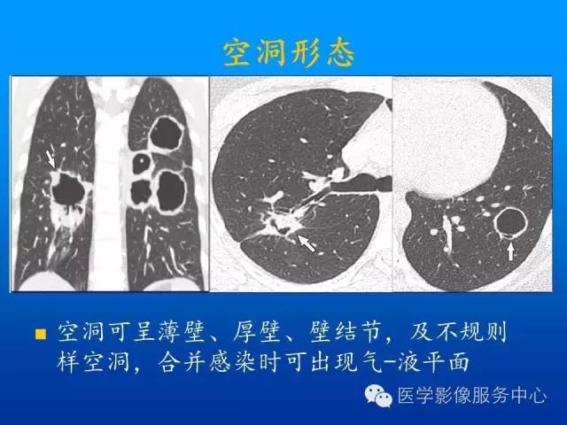 【病例】肺韦格氏肉芽肿1例CT影像表现