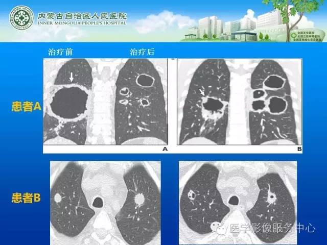 【病例】肺韦格氏肉芽肿1例CT影像表现