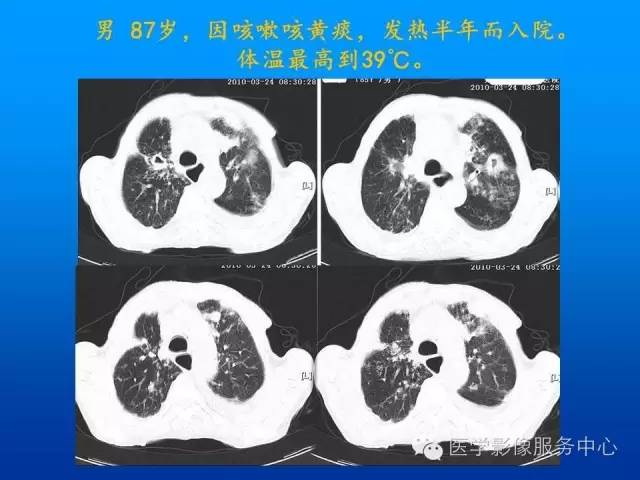 【病例】肺韦格氏肉芽肿1例CT影像表现