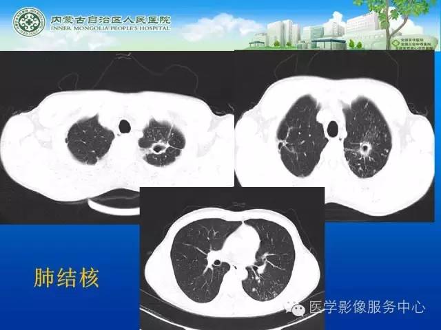 【病例】肺韦格氏肉芽肿1例CT影像表现