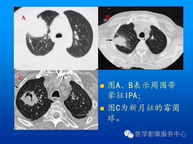 【病例】肺韦格氏肉芽肿1例CT影像表现