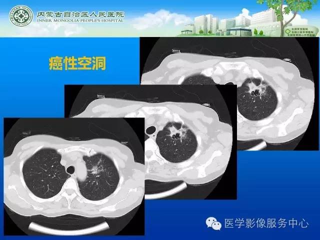 【病例】肺韦格氏肉芽肿1例CT影像表现