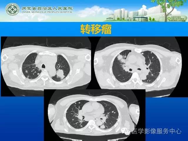 【病例】肺韦格氏肉芽肿1例CT影像表现