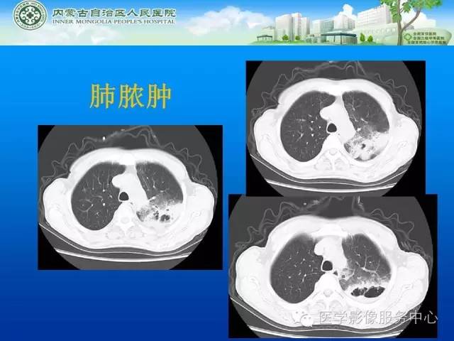 【病例】肺韦格氏肉芽肿1例CT影像表现