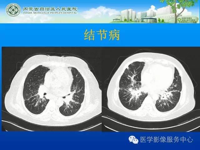 【病例】肺韦格氏肉芽肿1例CT影像表现