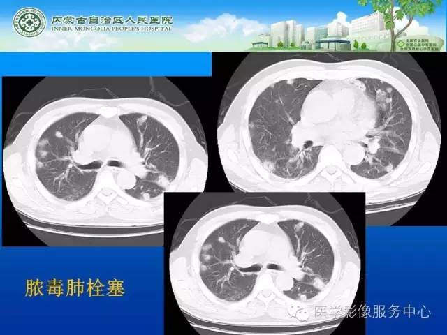 【病例】肺韦格氏肉芽肿1例CT影像表现