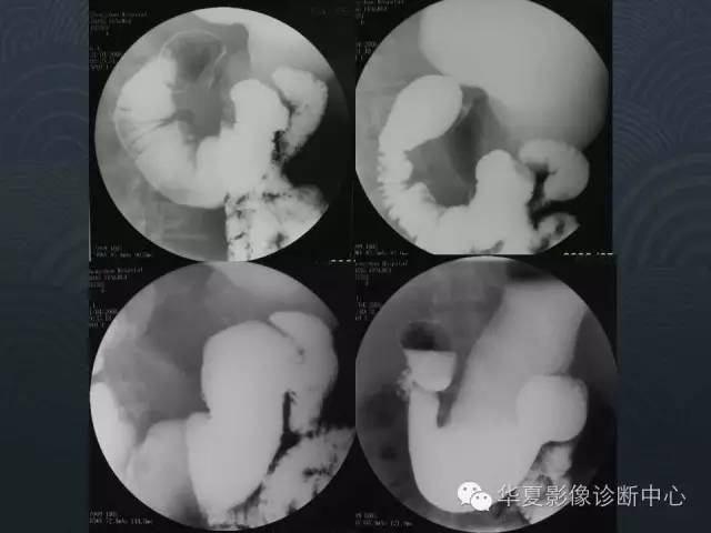 【病例】十二指肠神经内分泌肿瘤1例CT影像表现