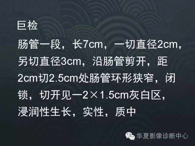 【病例】十二指肠神经内分泌肿瘤1例CT影像表现