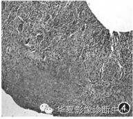 【病例】肺组织胞浆菌病影像表现1例