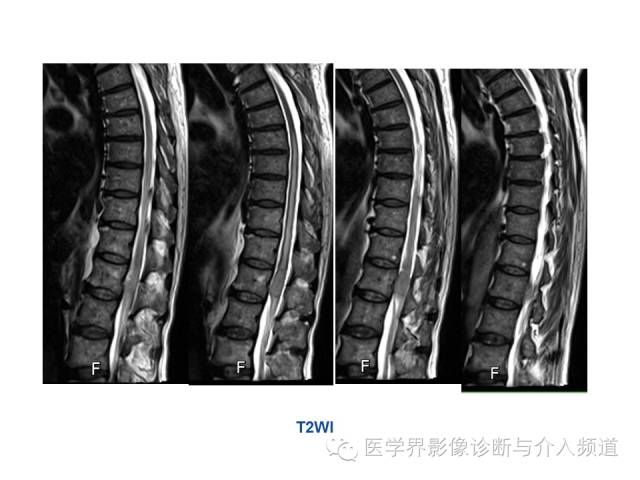 【病例】椎管占位转移性神经内分泌癌1例MR影像表现