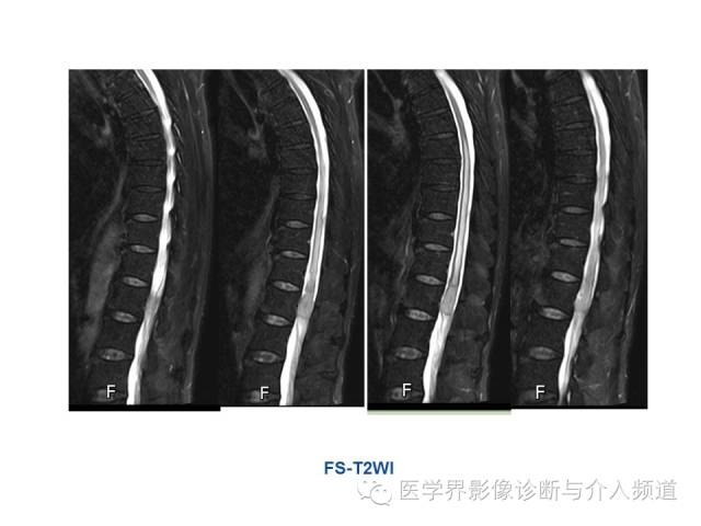 【病例】椎管占位转移性神经内分泌癌1例MR影像表现