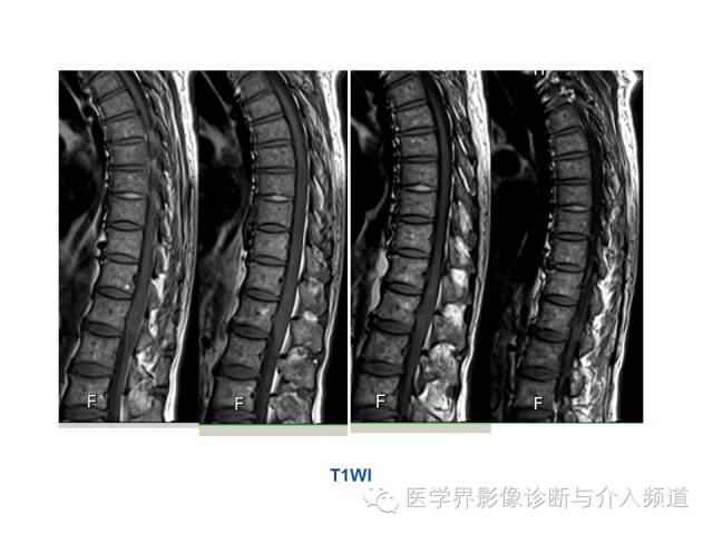 【病例】椎管占位转移性神经内分泌癌1例MR影像表现