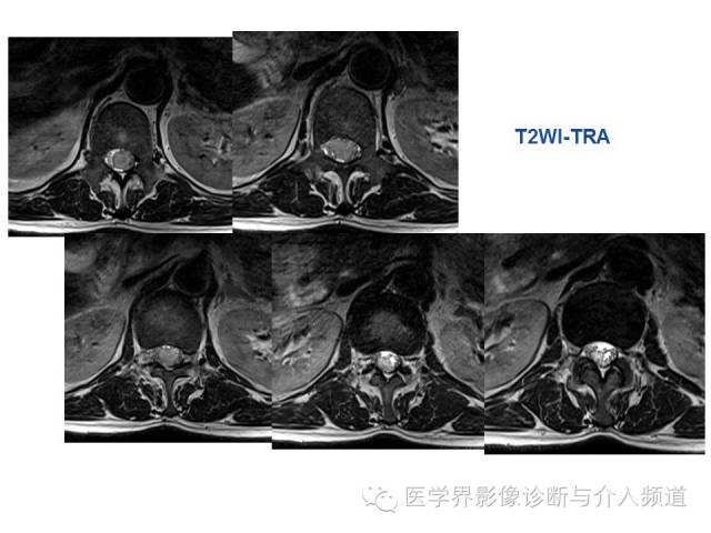 【病例】椎管占位转移性神经内分泌癌1例MR影像表现
