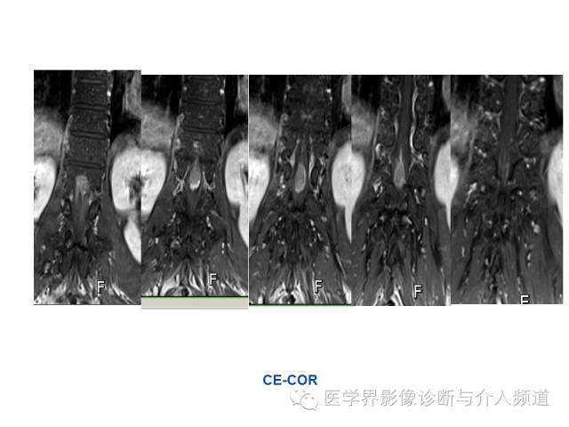【病例】椎管占位转移性神经内分泌癌1例MR影像表现
