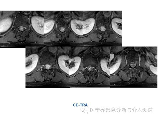 【病例】椎管占位转移性神经内分泌癌1例MR影像表现