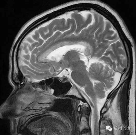Marchiafava-Bignami Disease (MBD)-胼胝体少见疾病的诊断与鉴别诊断