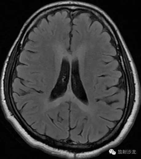 Marchiafava-Bignami Disease (MBD)-胼胝体少见疾病的诊断与鉴别诊断 Marchiafava-Bignami Disease (MBD)-胼胝体少见疾病的诊断与鉴别诊断