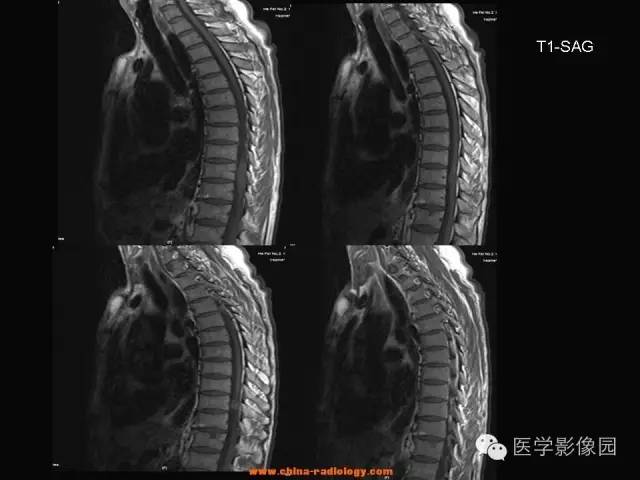 【病例】椎管内神经鞘瘤1例MR影像表现