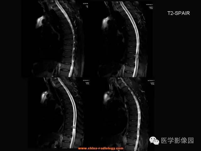 【病例】椎管内神经鞘瘤1例MR影像表现 【病例】椎管内神经鞘瘤1例MR影像表现