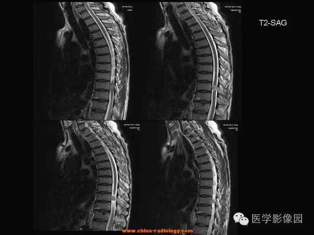 【病例】椎管内神经鞘瘤1例MR影像表现 【病例】椎管内神经鞘瘤1例MR影像表现