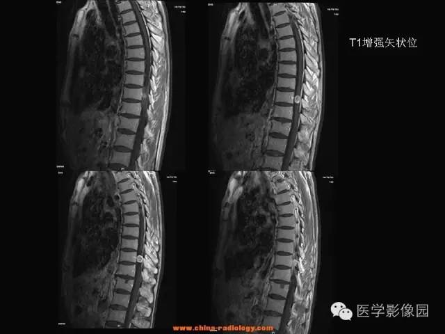 【病例】椎管内神经鞘瘤1例MR影像表现 【病例】椎管内神经鞘瘤1例MR影像表现