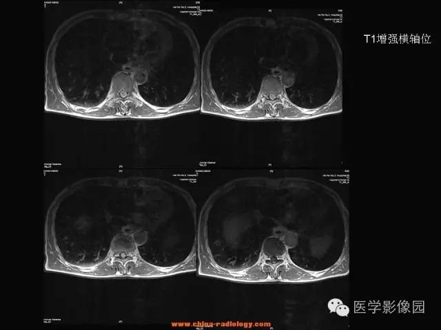 【病例】椎管内神经鞘瘤1例MR影像表现 【病例】椎管内神经鞘瘤1例MR影像表现