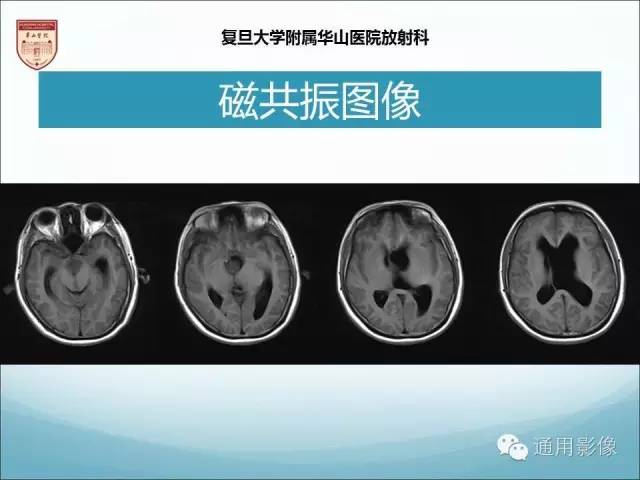 【病例】三脑室孤立性纤维瘤/血管外皮瘤1例MR影像表现