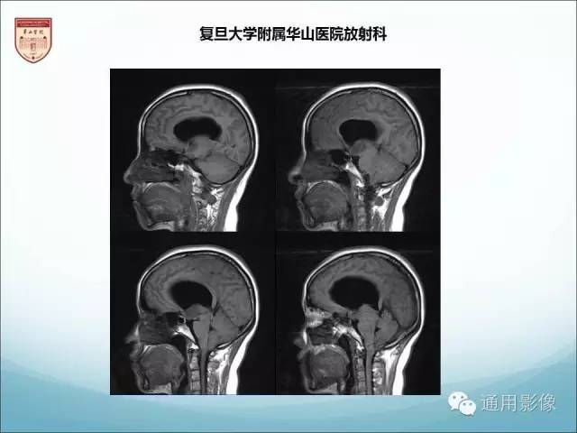 【病例】三脑室孤立性纤维瘤/血管外皮瘤1例MR影像表现