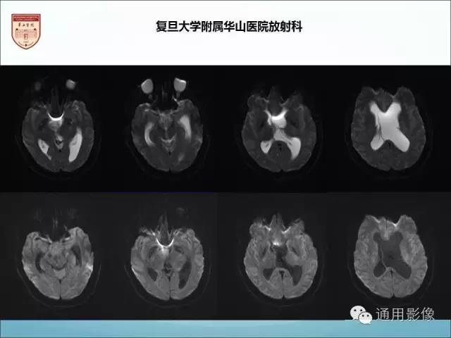 【病例】三脑室孤立性纤维瘤/血管外皮瘤1例MR影像表现