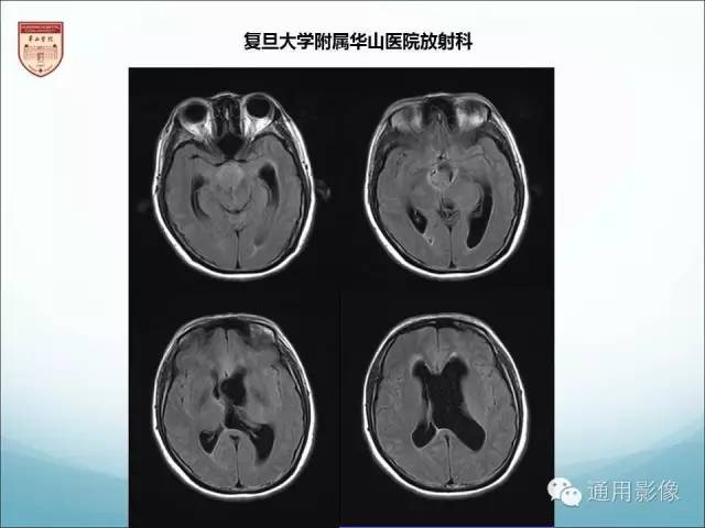 【病例】三脑室孤立性纤维瘤/血管外皮瘤1例MR影像表现