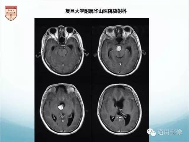 【病例】三脑室孤立性纤维瘤/血管外皮瘤1例MR影像表现