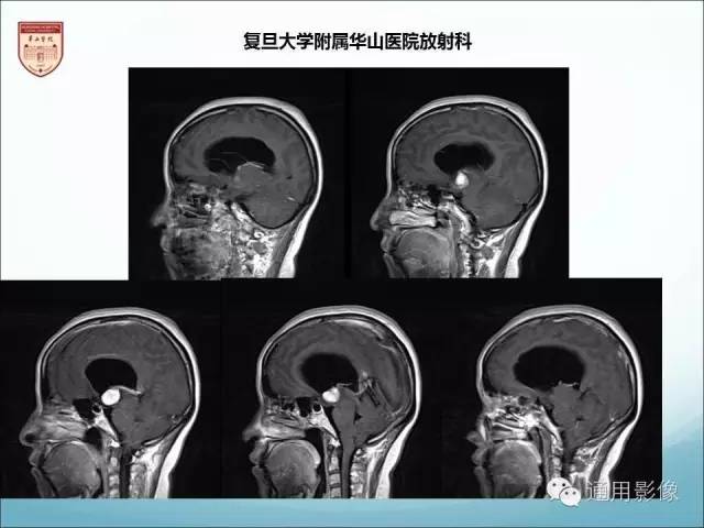 【病例】三脑室孤立性纤维瘤/血管外皮瘤1例MR影像表现