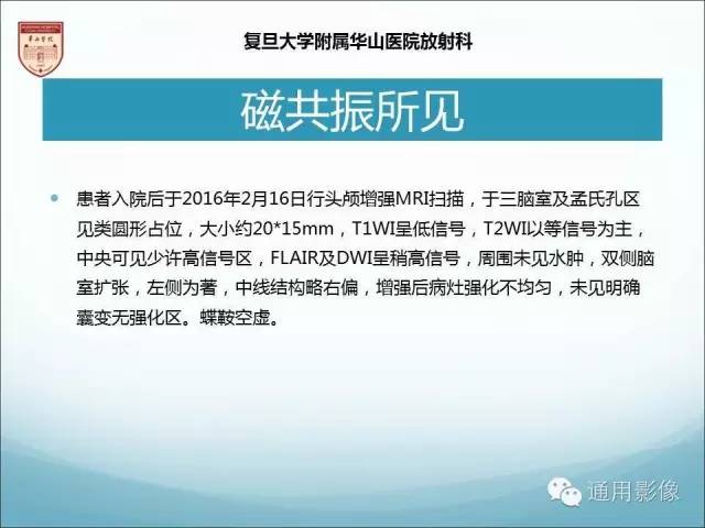【病例】三脑室孤立性纤维瘤/血管外皮瘤1例MR影像表现
